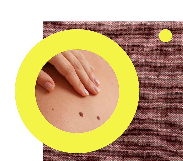 Nahaufnahme einer Hand, die vorsichtig über den Rücken streicht, auf dem drei dunkle Muttermale zu sehen sind.