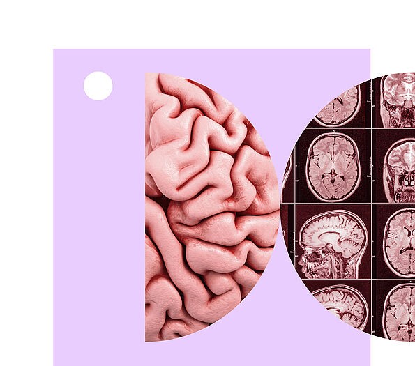 Collage mit Gehirnbildern, wobei das linke eine Gehirnoberfläche zeigt, das rechte histologische Schnitte.